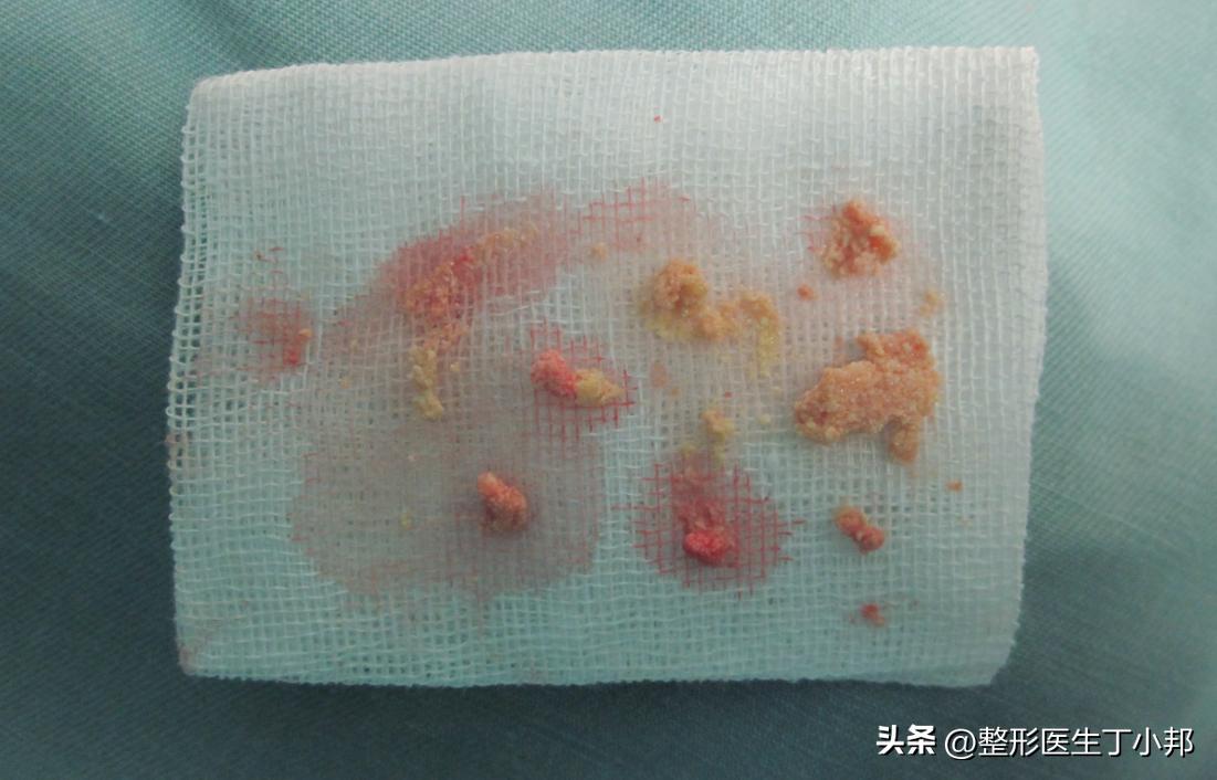手术室实拍：手术中取出来的微晶瓷。#丁小邦注射物取出#故事