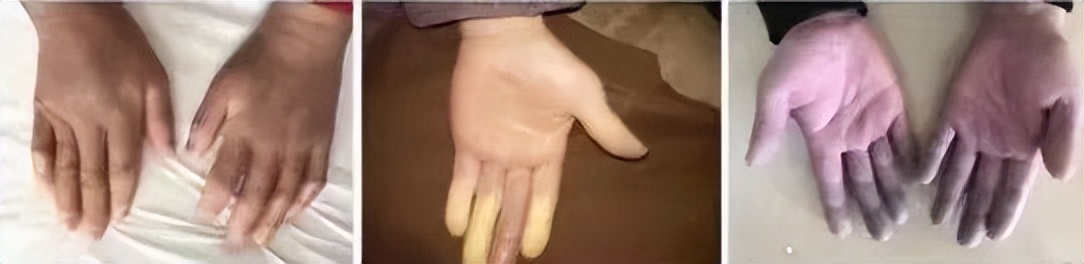 风湿免疫类疾病最怕什么,风湿免疫疾病如何预防