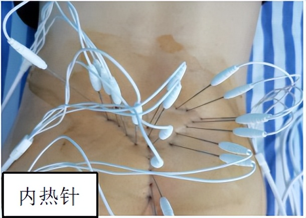 骨科必看的科普｜|得了腰椎间盘突出症，选择何种治疗方式才好？