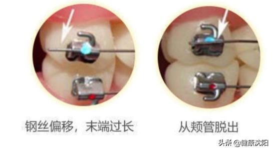 牙齿矫正必问医生的问题,健康科普儿童牙外伤怎么办