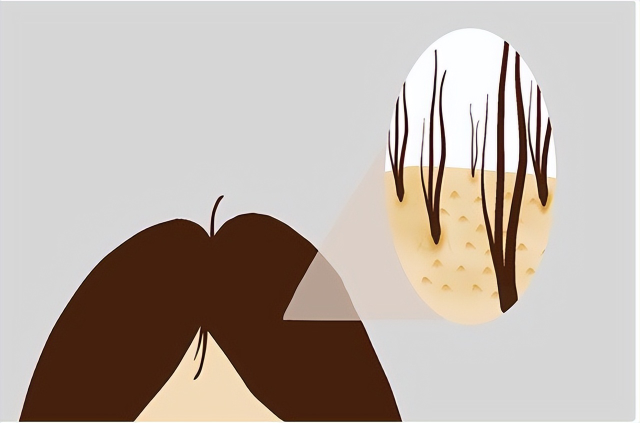 头皮上经常长脓包,头皮经常起疙瘩有脓包是什么原因