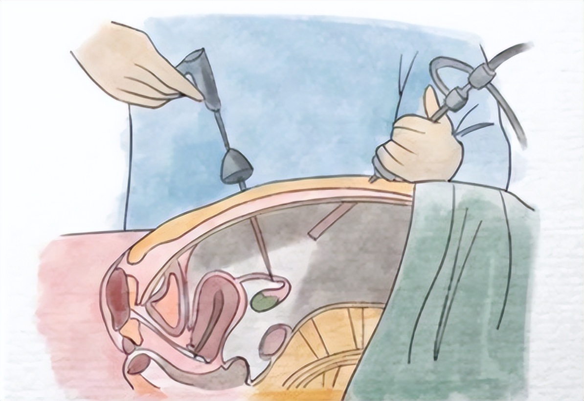 肠道多发息肉还是单发息肉严重,肠道扁平息肉厉害还是息肉厉害