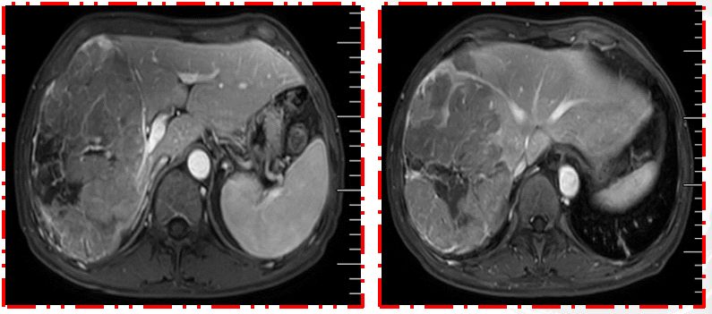 病例分享丨晚期肝癌治疗新策略，把不可能变为可能！