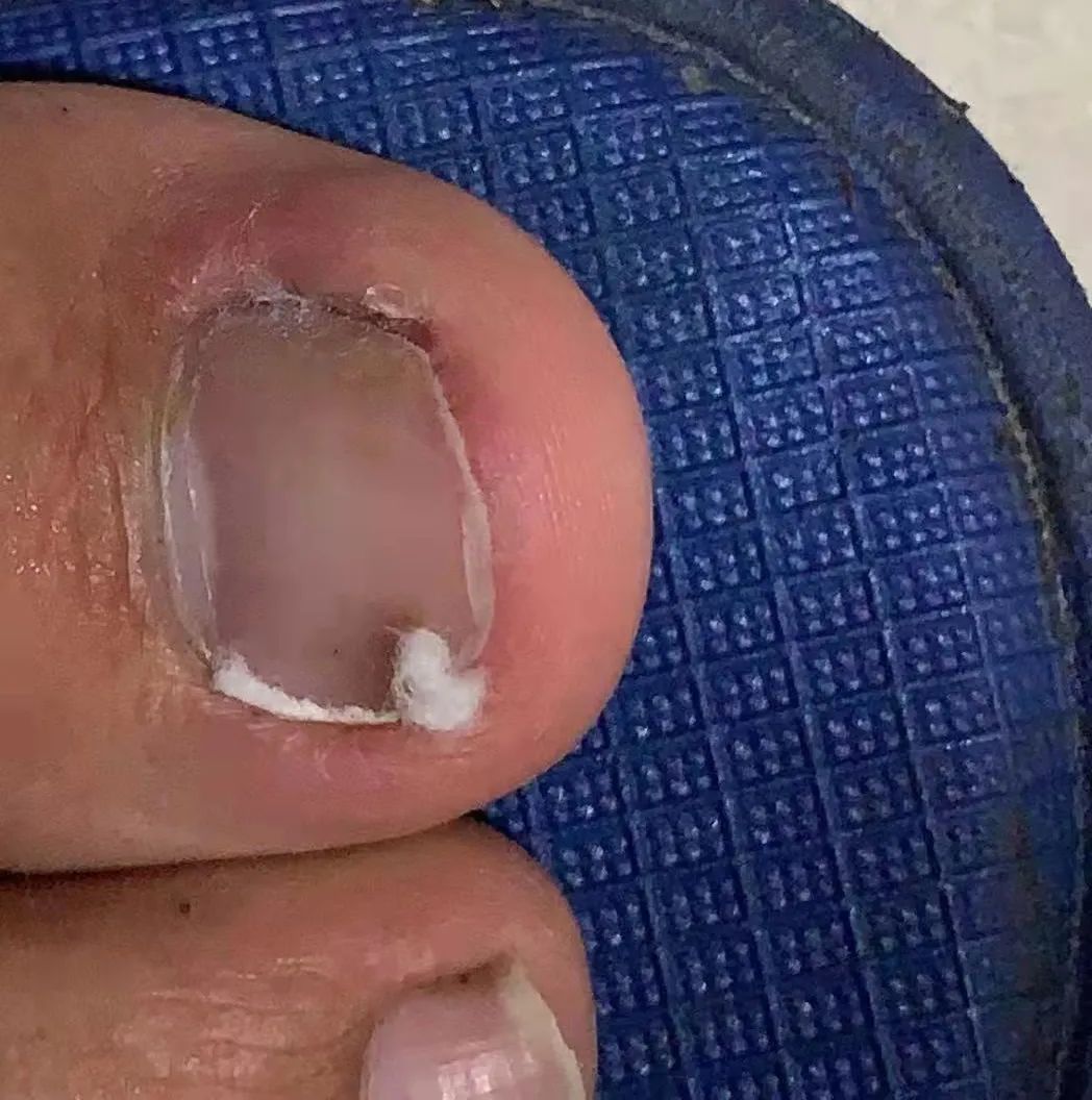 嵌甲疼痛难忍,嵌甲怎么才能有效缓解疼痛