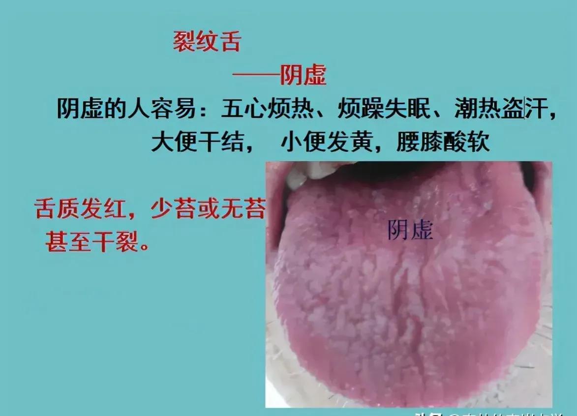 阴虚裂纹舌怎么调理,裂纹舌调理的经历