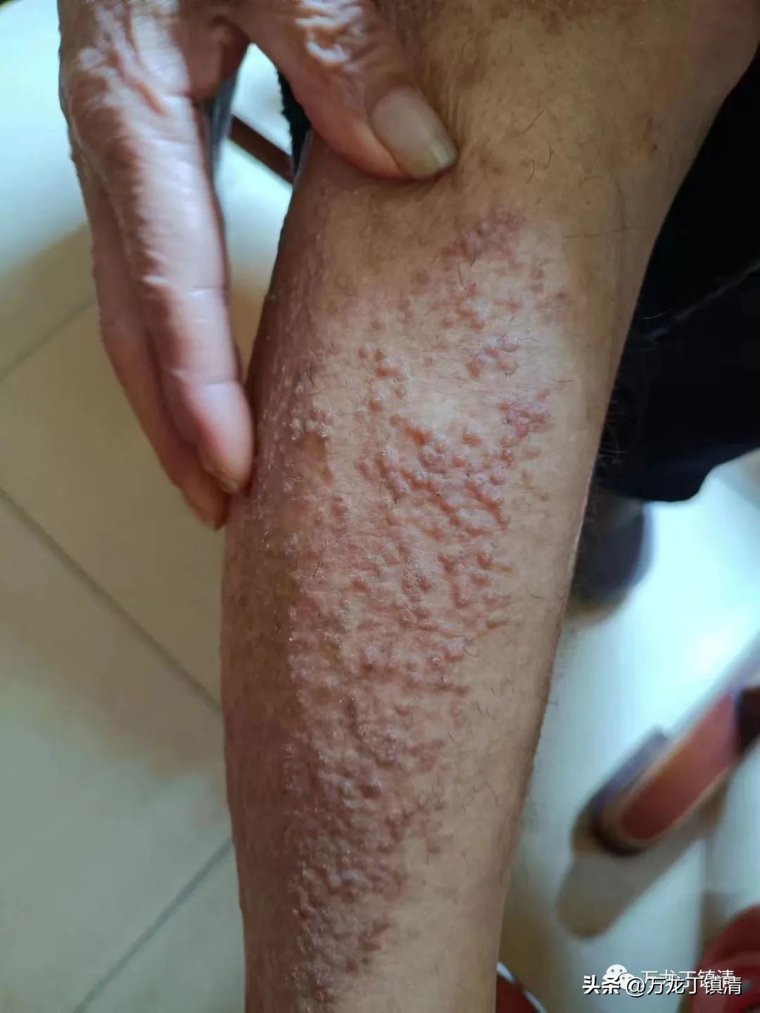 养血祛风汤治老年性皮肤瘙痒症,四君子汤能冶老年皮肤瘙痒吗