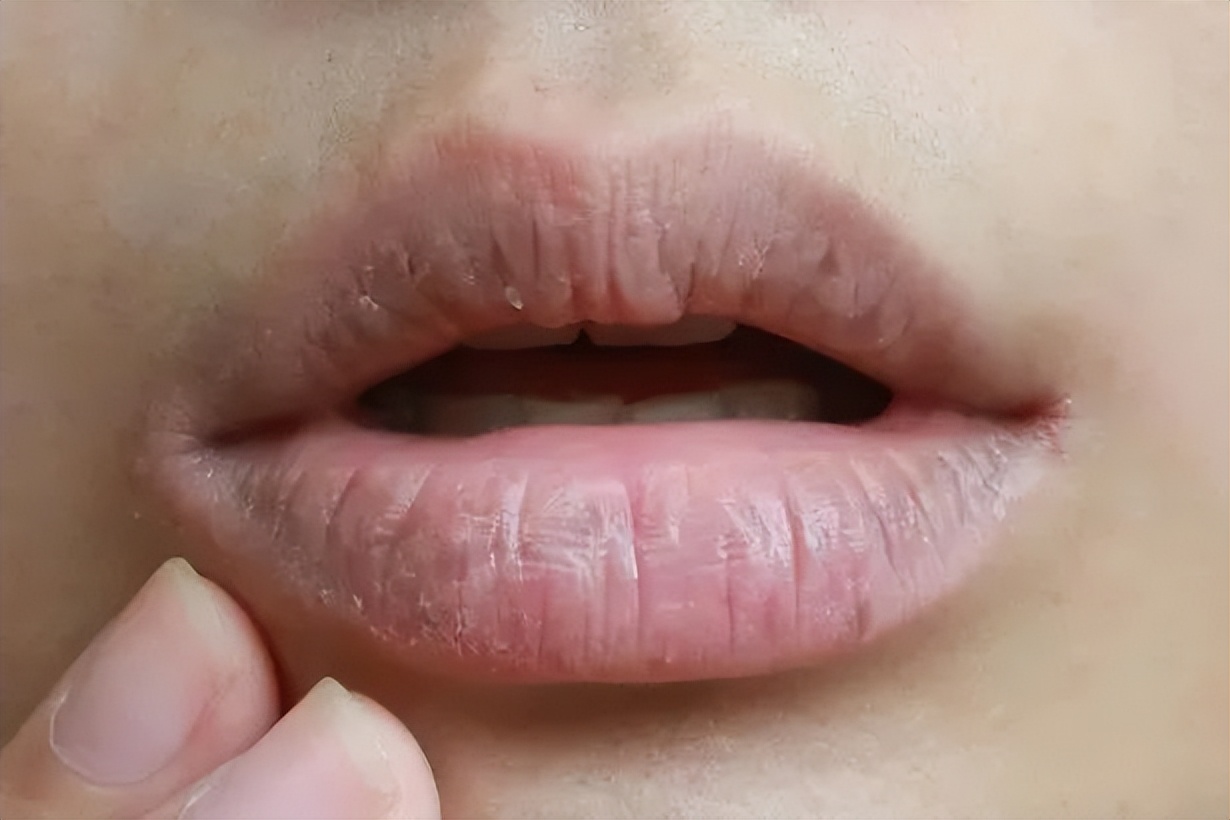 嘴巴起皮干燥润唇膏,嘴巴干燥起皮润唇膏