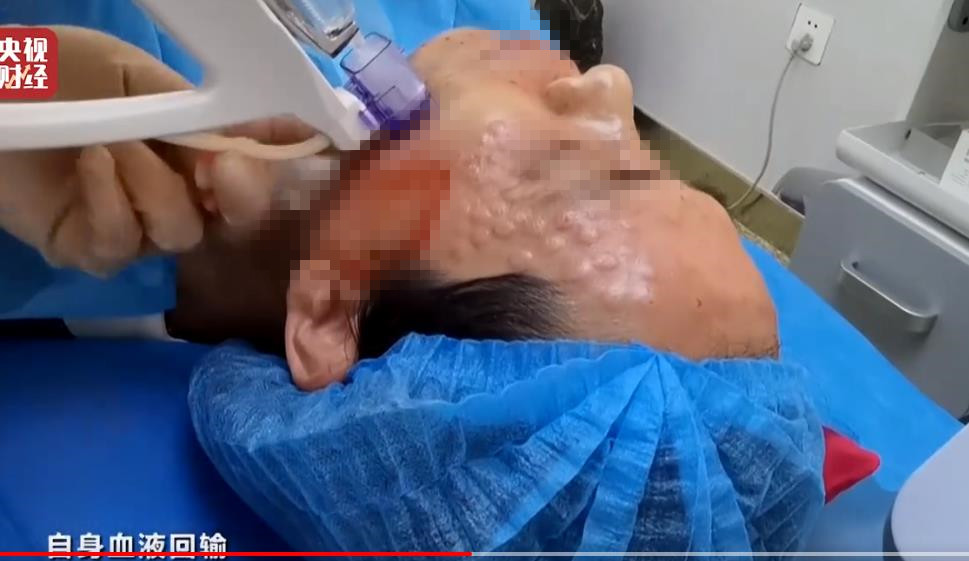 315曝光美容注射,315美容针曝光