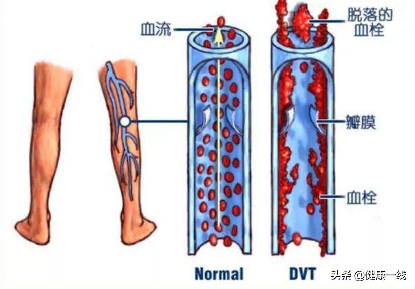 脉管炎预防方法,脉管炎最佳防治方法中药