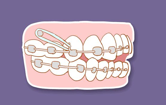 牙齿缺失是镶好还是种好,牙齿不齐是前世做了什么