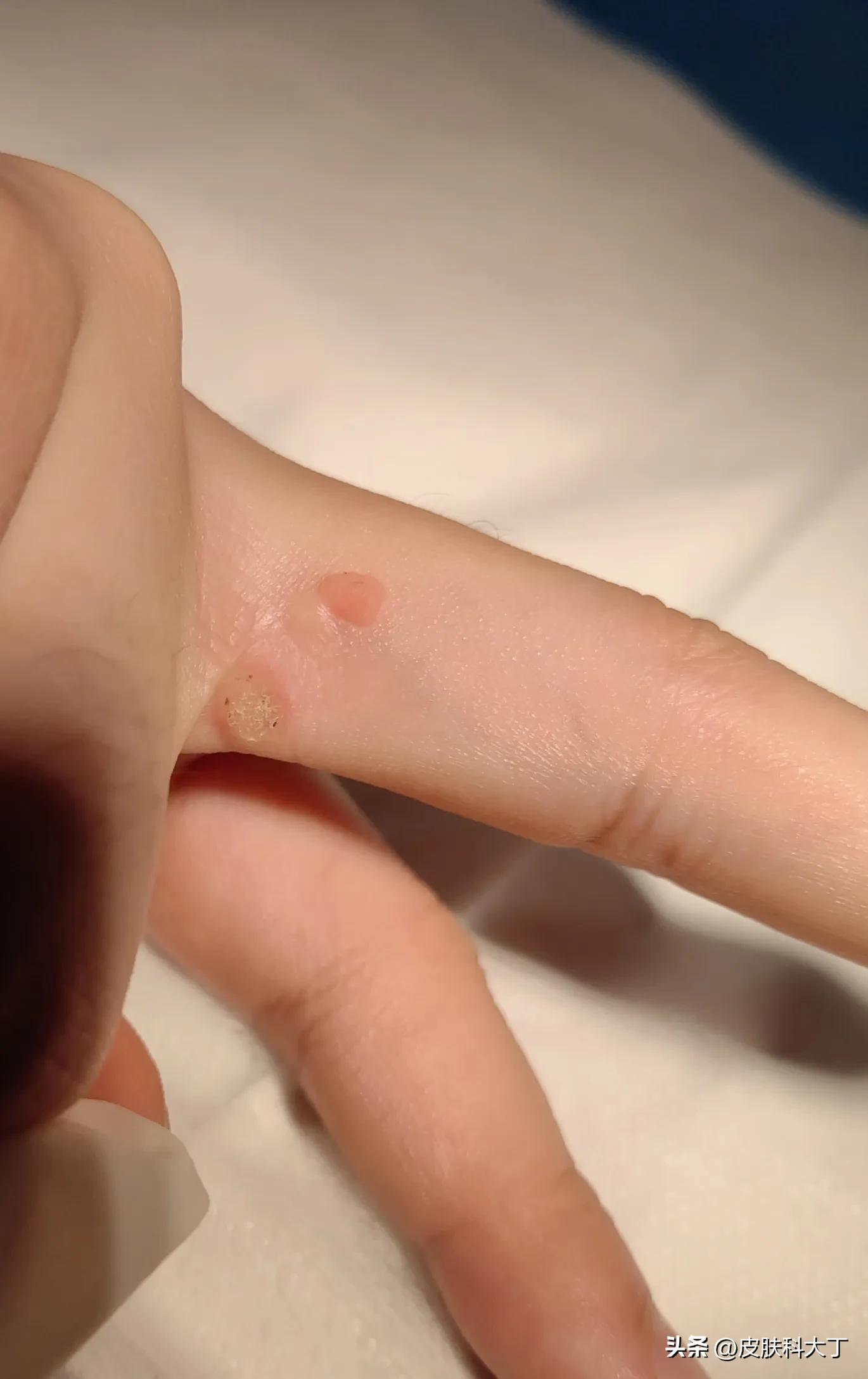 不慎感染HPV病毒长疙瘩，这种有效、价格便宜的治疗你一定要看看