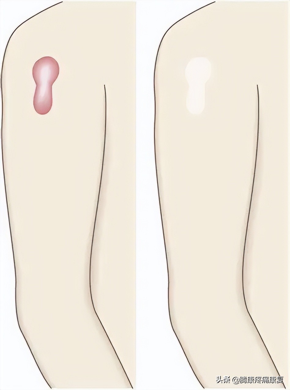 皮质类固醇贴剂治疗瘢痕疙瘩,类固醇激素治疗疤痕增生