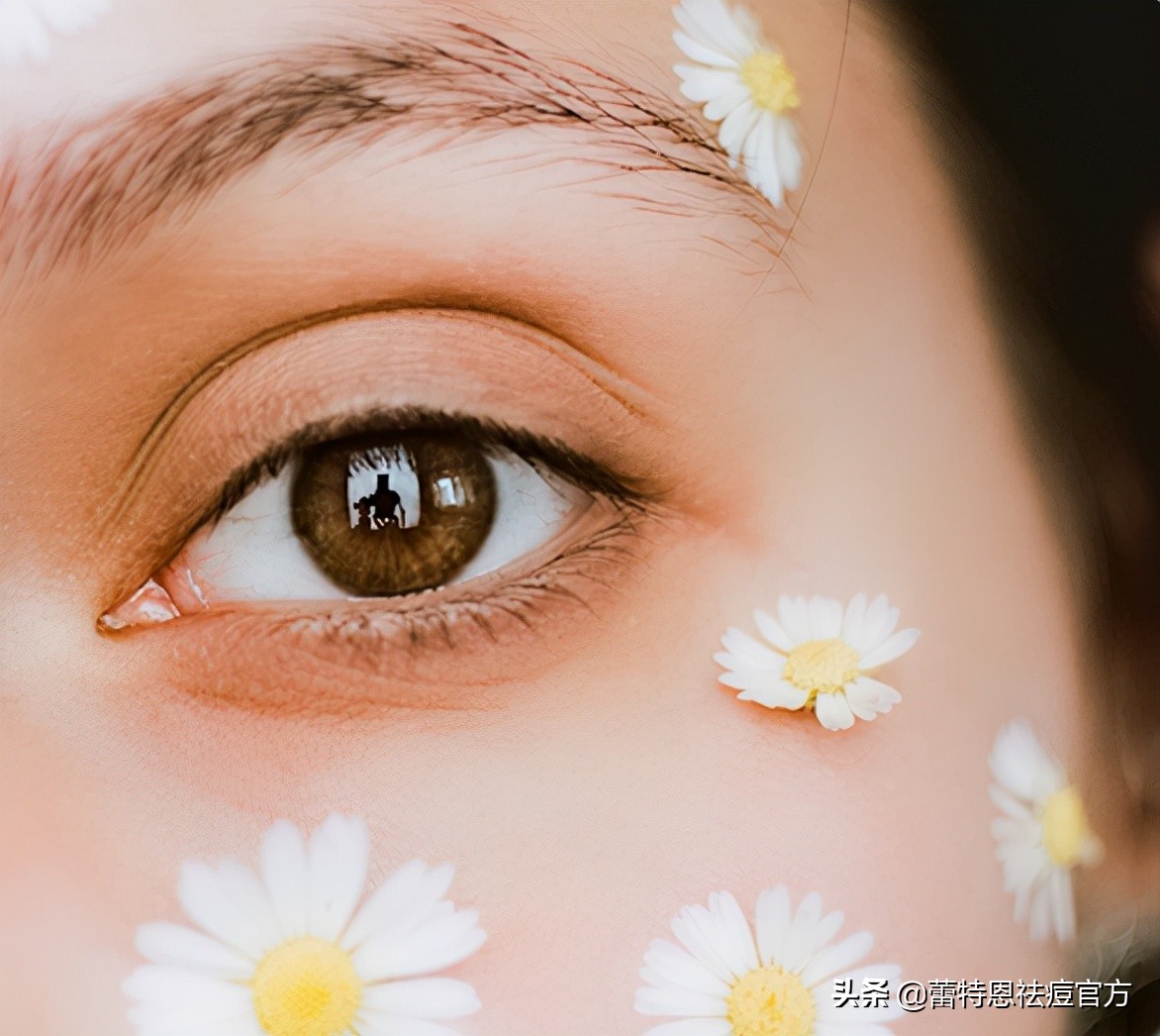 蕾特恩痘印,蕾特恩祛痘留下痘印