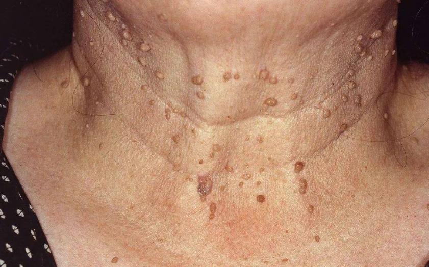 皮肤长的小肉球怎么自己处理,皮肤长出小肉球是什么原因