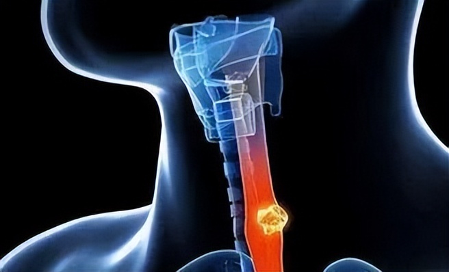 肿瘤放疗后恶心呕吐怎么办,肿瘤恶心呕吐吃什么好得快