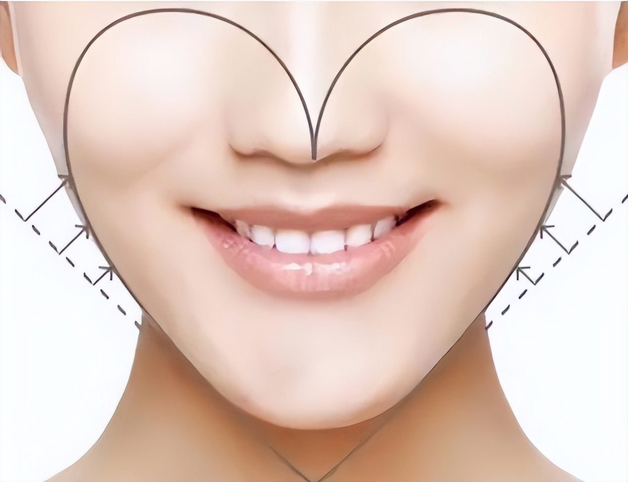 苹果肌塌陷不饱满怎么办,苹果肌干瘪怎么办