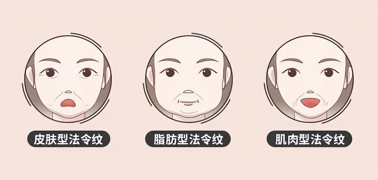 遗传的法令纹特别显老怎么办,眼睛泪沟和法令纹显老怎么办