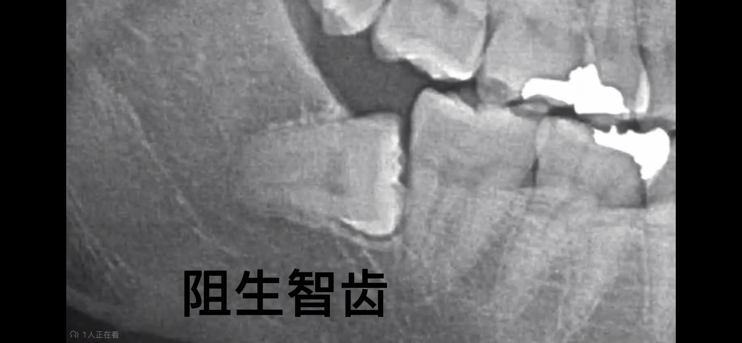 智齿最难的拔牙全过程,垂直阻生智齿拔掉痛苦吗