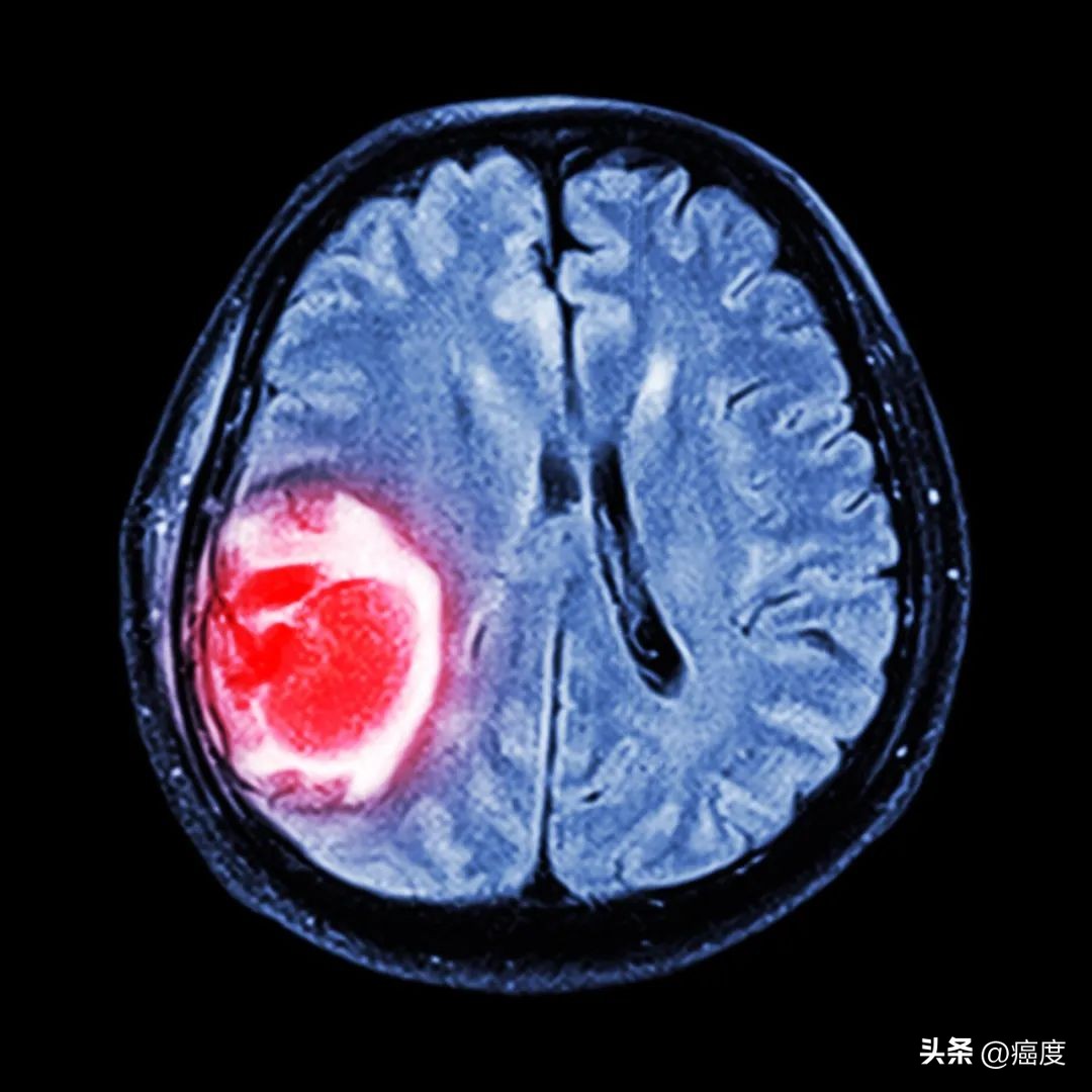 脑部放疗预防,预防脑转移放疗需要多少钱