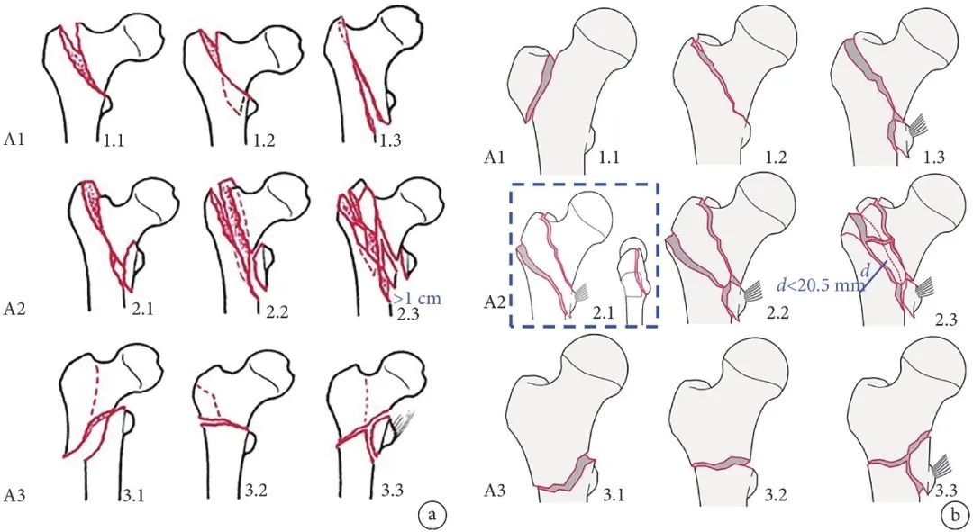 股骨转子间骨折四种手术方法比较,股骨转子间骨折属于轻伤还是重伤