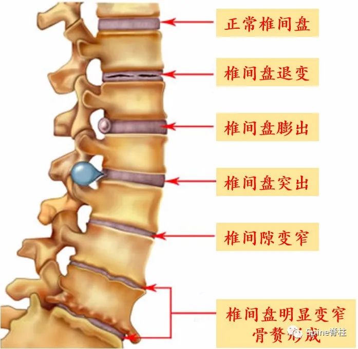 腰椎间盘突出症状表现,腰椎间盘突出症疼痛最佳止痛方法