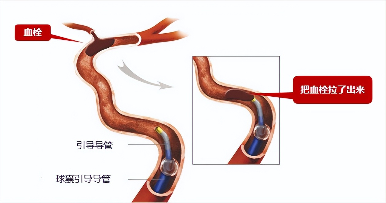 溶栓取栓错过了最佳时机怎么办,脑梗错过溶栓取栓时间后怎么治疗