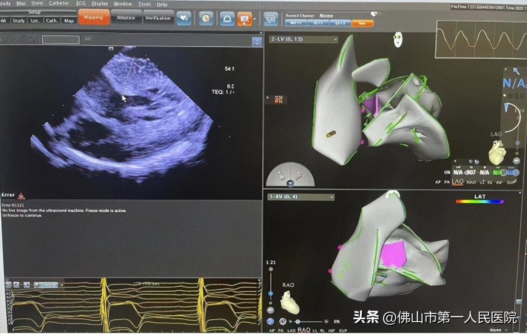 肥厚型心肌病能做射频消融手术吗,肥厚型梗阻性心肌病射频消融治疗