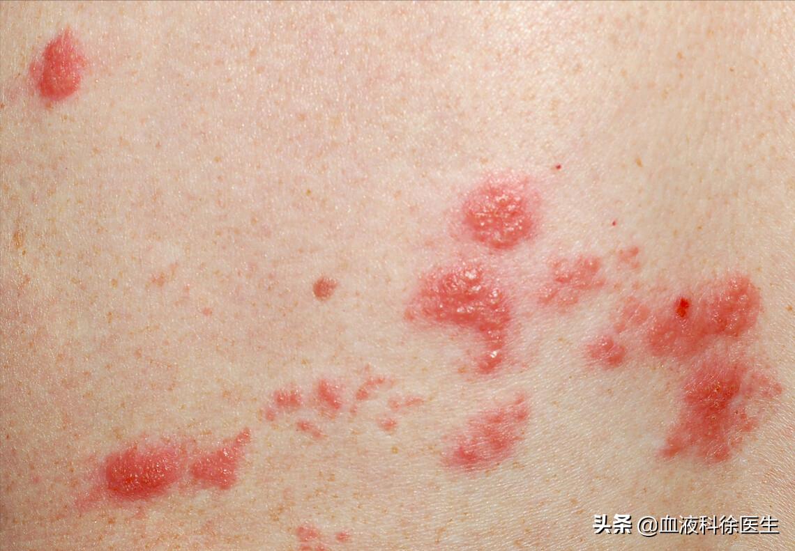 有种剧痛叫带状疱疹,有一种痛叫带状疱疹七类人要小心