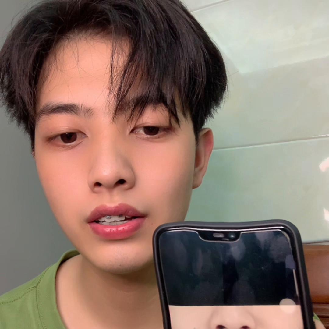 牙套怎么固定在牙上的,牙套矫正过程