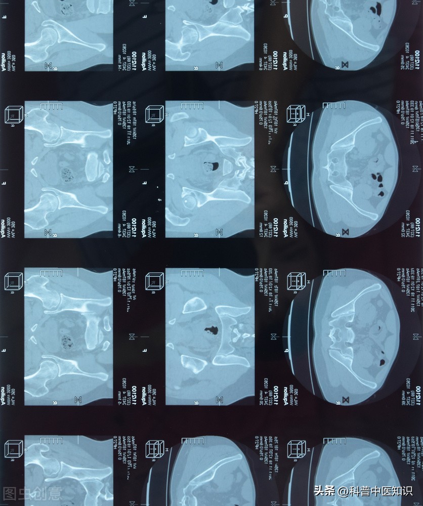 打通督脉强直性脊柱炎的中医疗法,治疗强直性脊柱炎中医还是西医好