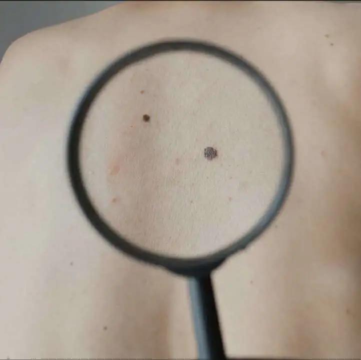 如何区别黑痣和黑色素瘤,怎么分清是黑色素瘤还是黑色的痣