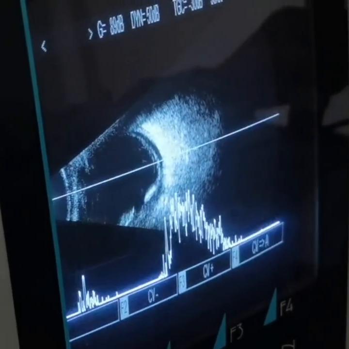 眼底超声检查视网膜裂孔,眼科b超能看出视网膜脱落吗