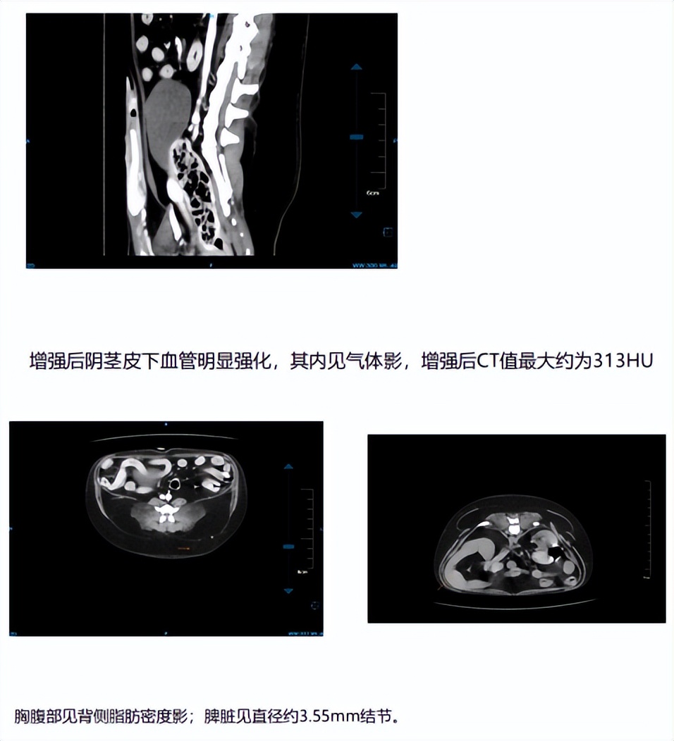 射频理疗治疗椎间盘突出,激光治疗腰椎间盘突出的图片