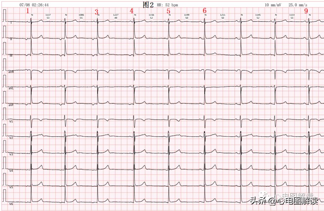 窦房结游走心律的临床意义,窦房结游走心律心电图特征