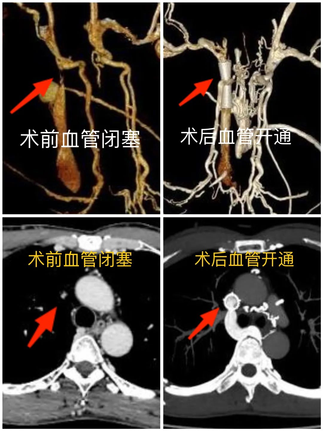警惕老人脸肿,警惕中风年轻化