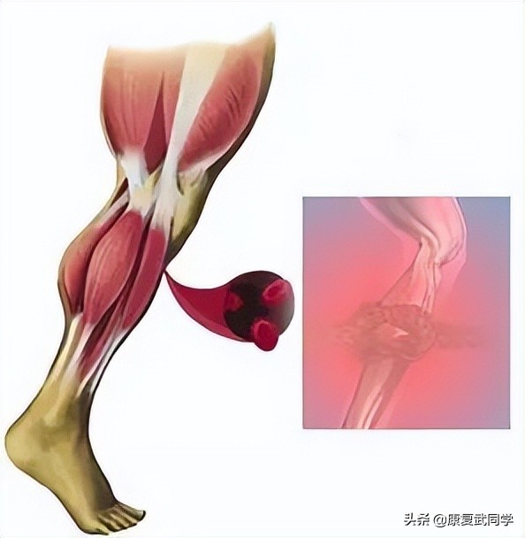 小腿肌肉拉伤康复训练视频,小腿肌肉拉伤后康复训练