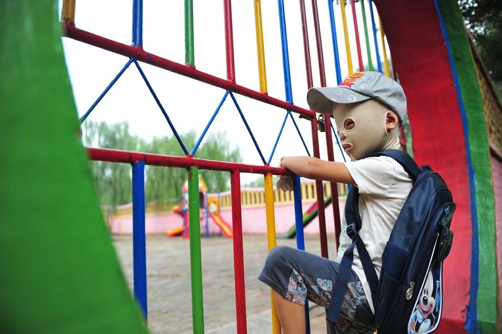 小孩被火烧伤戴面具,面具娃娃烧伤