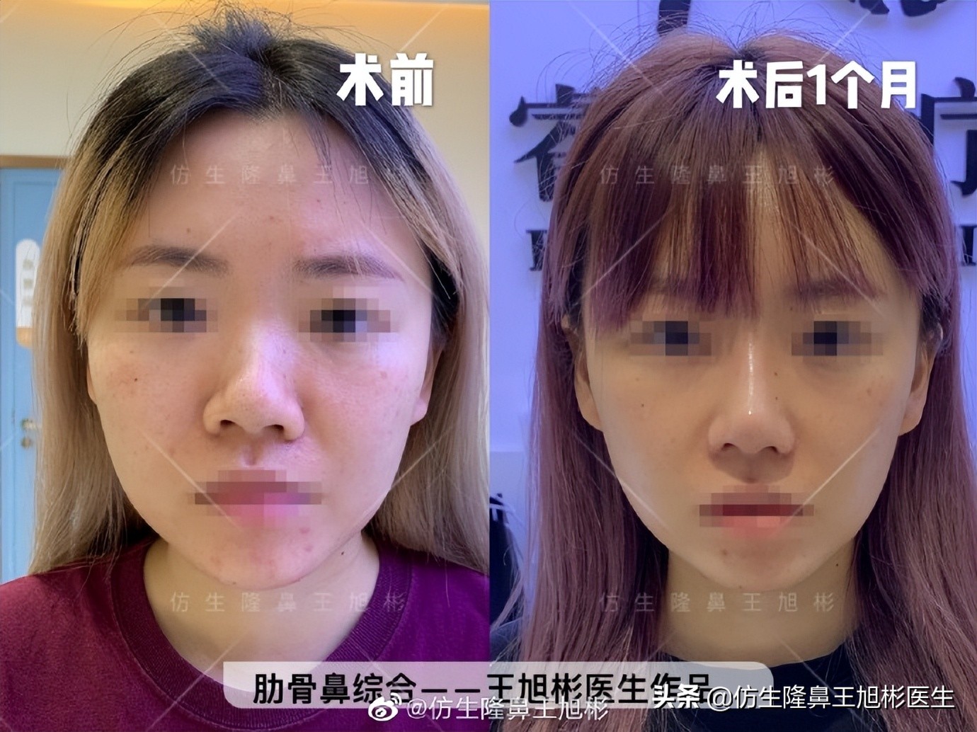 做一次鼻头缩小要多少钱好,可以只做鼻头缩鼻翼吗