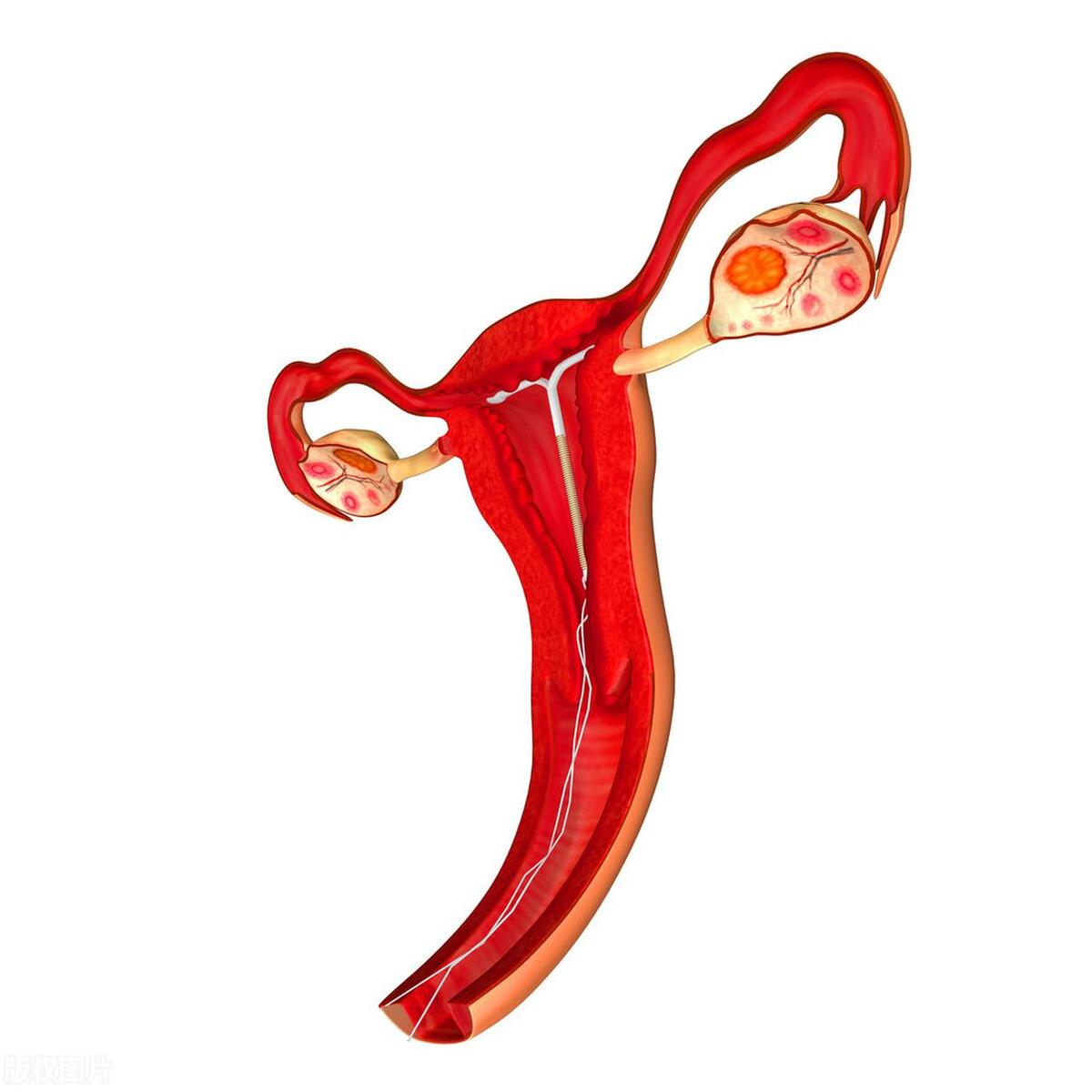 女性上环的种类和形状,女性上环的全部过程是什么