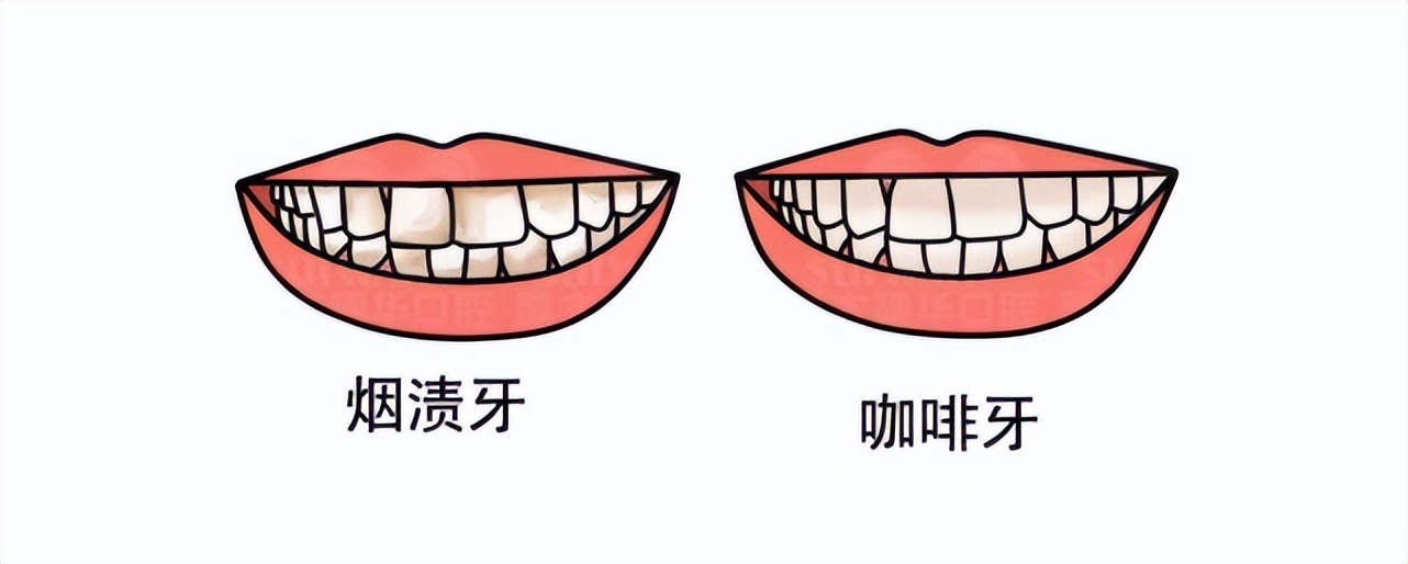 为什么天天刷牙牙齿还有黑斑,经常用美白牙膏为什么还是牙黄