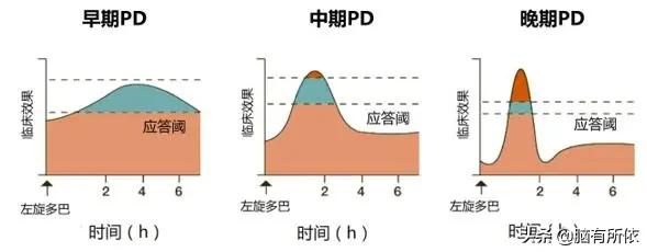 治疗帕金森病药物知多少丨达灵复：新一代复方左旋多巴制剂