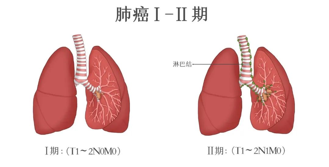 肺癌复发转移这么治，让癌细胞避无可避