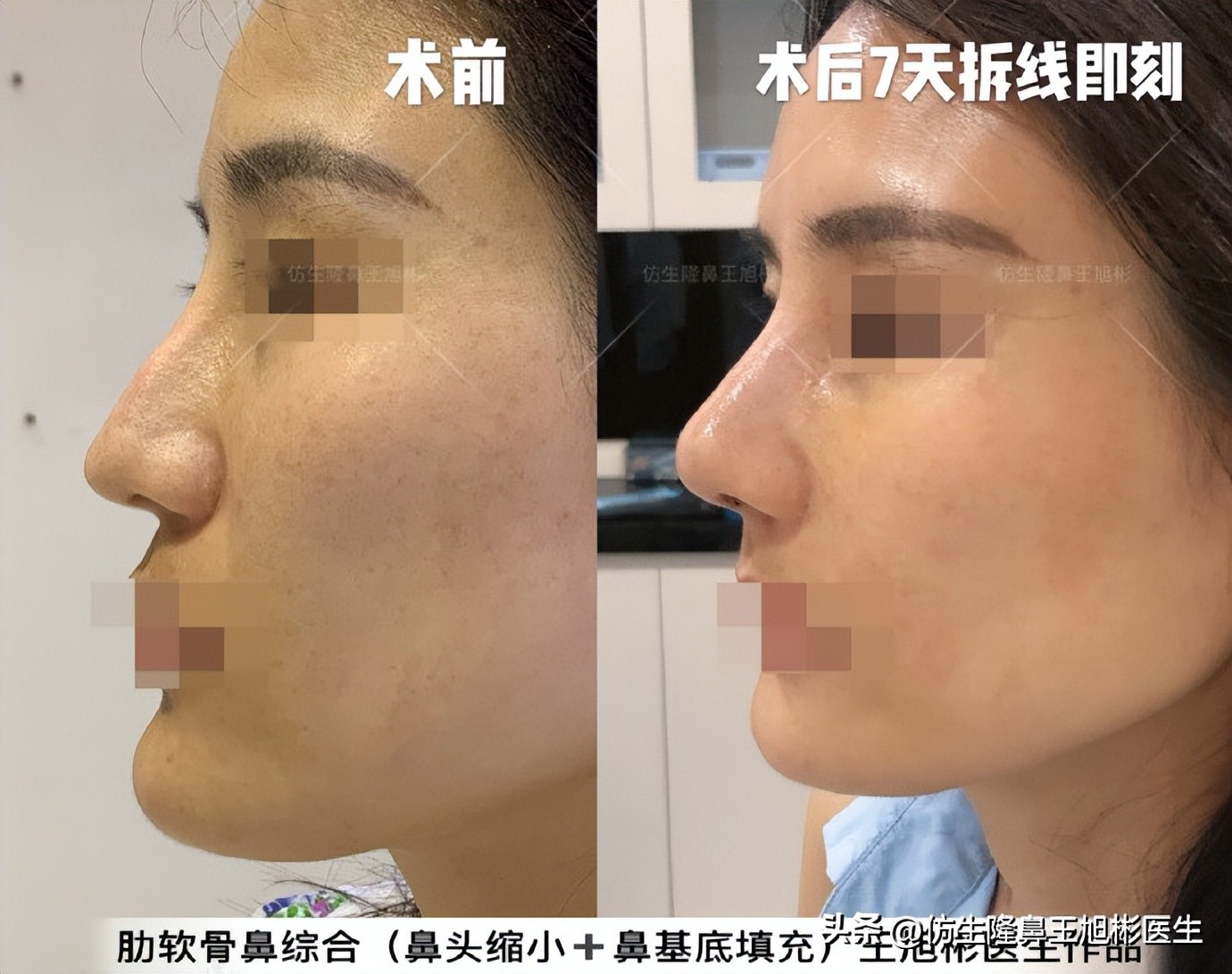 大鼻头能做直鼻微翘吗,可以只做鼻头缩小术吗