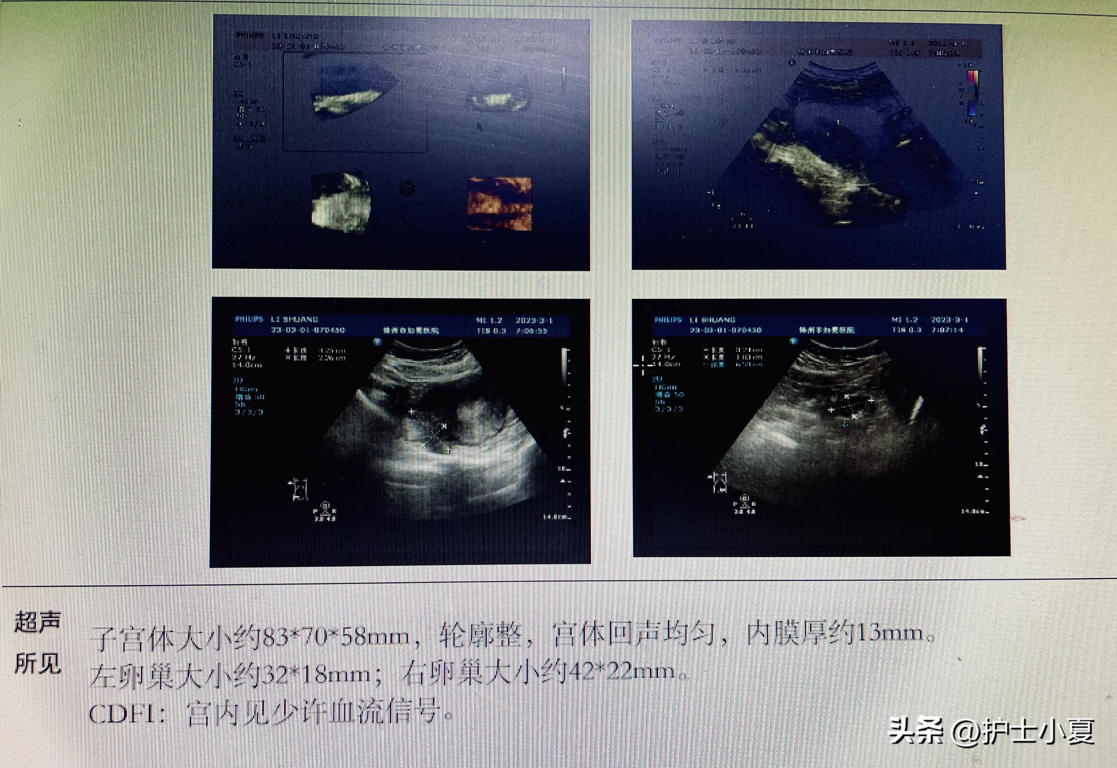 病例分享：25岁女孩，孕13周引产，引产后需要注意哪些？