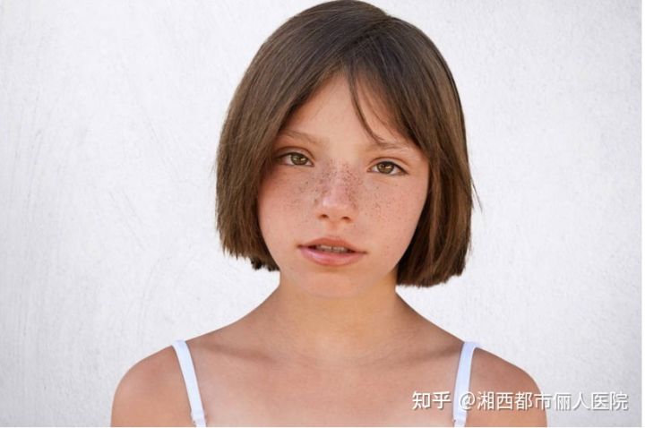 小女孩脸上长雀斑是什么原因,小女孩长雀斑怎么办