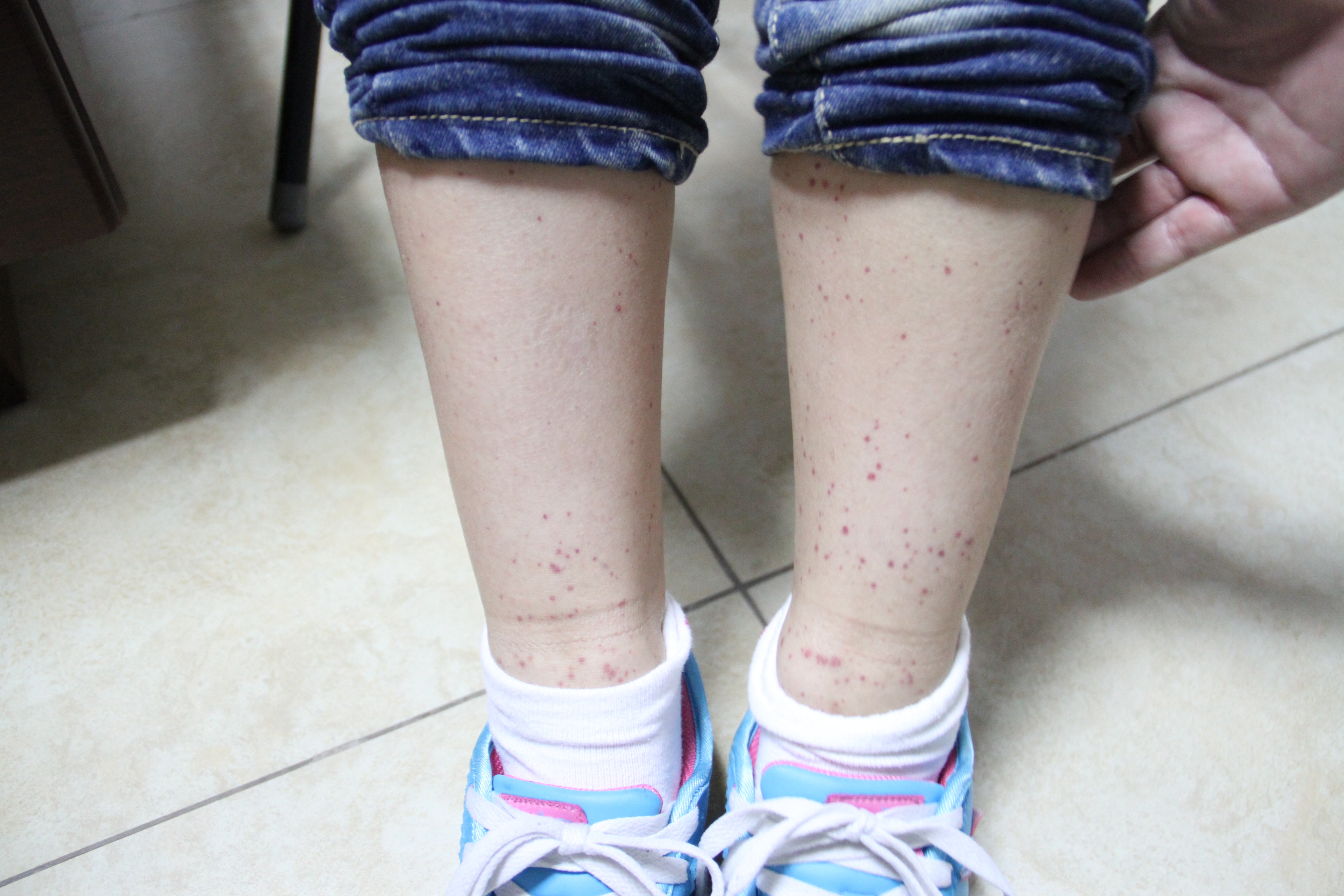 儿科过敏性紫癜个案护理范文,儿童过敏性紫癜护理问题及措施