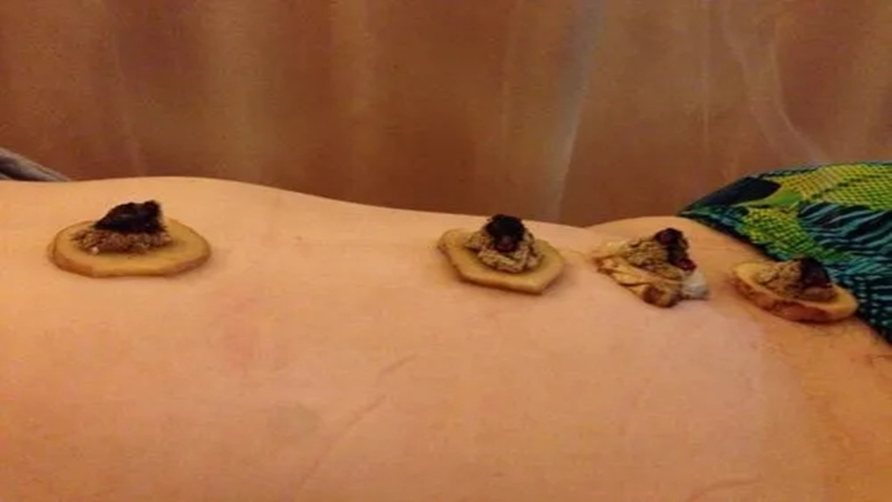 神经性皮炎能彻底治愈,神经性皮炎能彻底根治吗