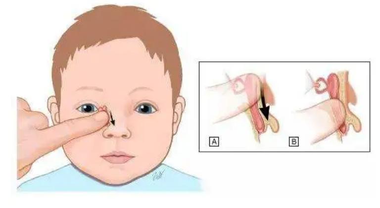 泪囊炎为什么导致眼泪结晶,眼睛泪囊炎症状