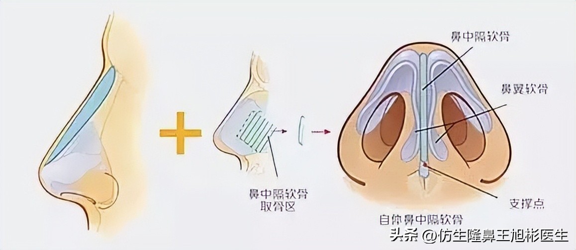 耳软骨隆鼻和肋软骨隆鼻图片对比,耳软骨隆鼻和假体耳软骨隆鼻