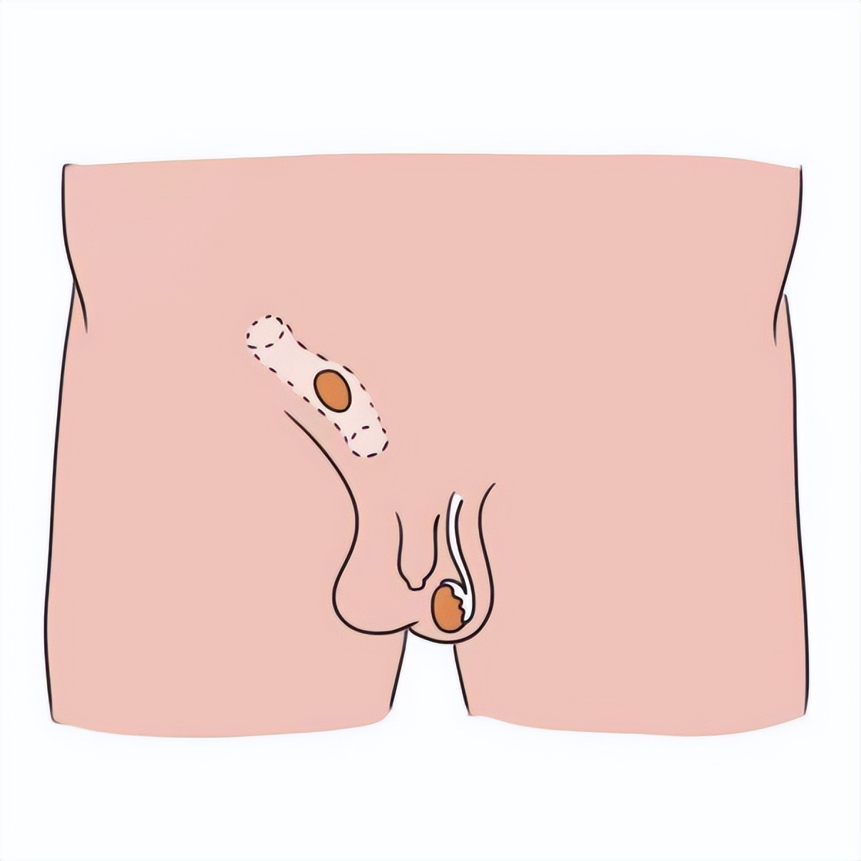 宝宝睾丸位置不对称什么原因,宝宝睾丸有时不对称怎么回事